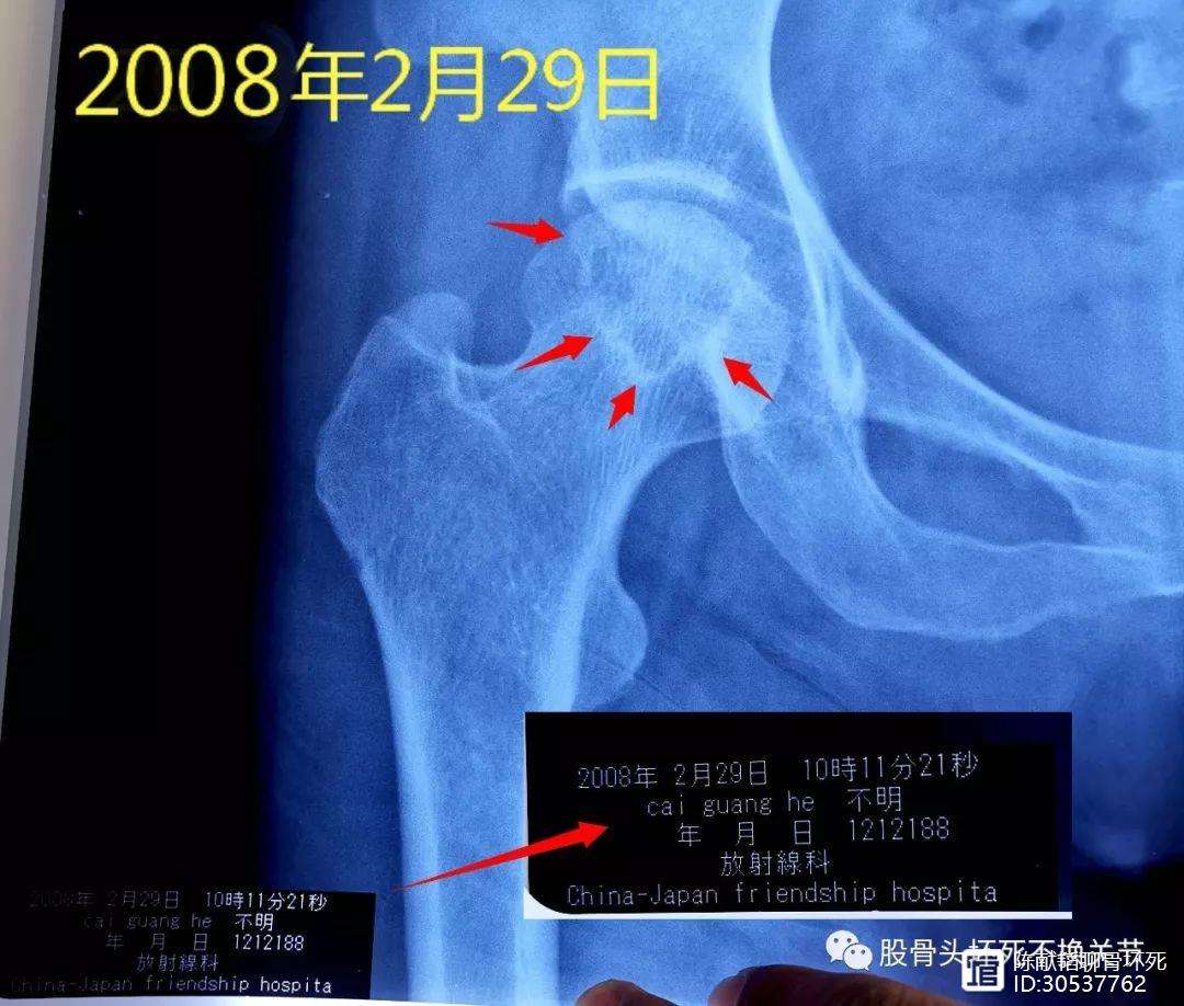 莱芜人工骨头医保报销多少(人工骨头医保报销多少比例)