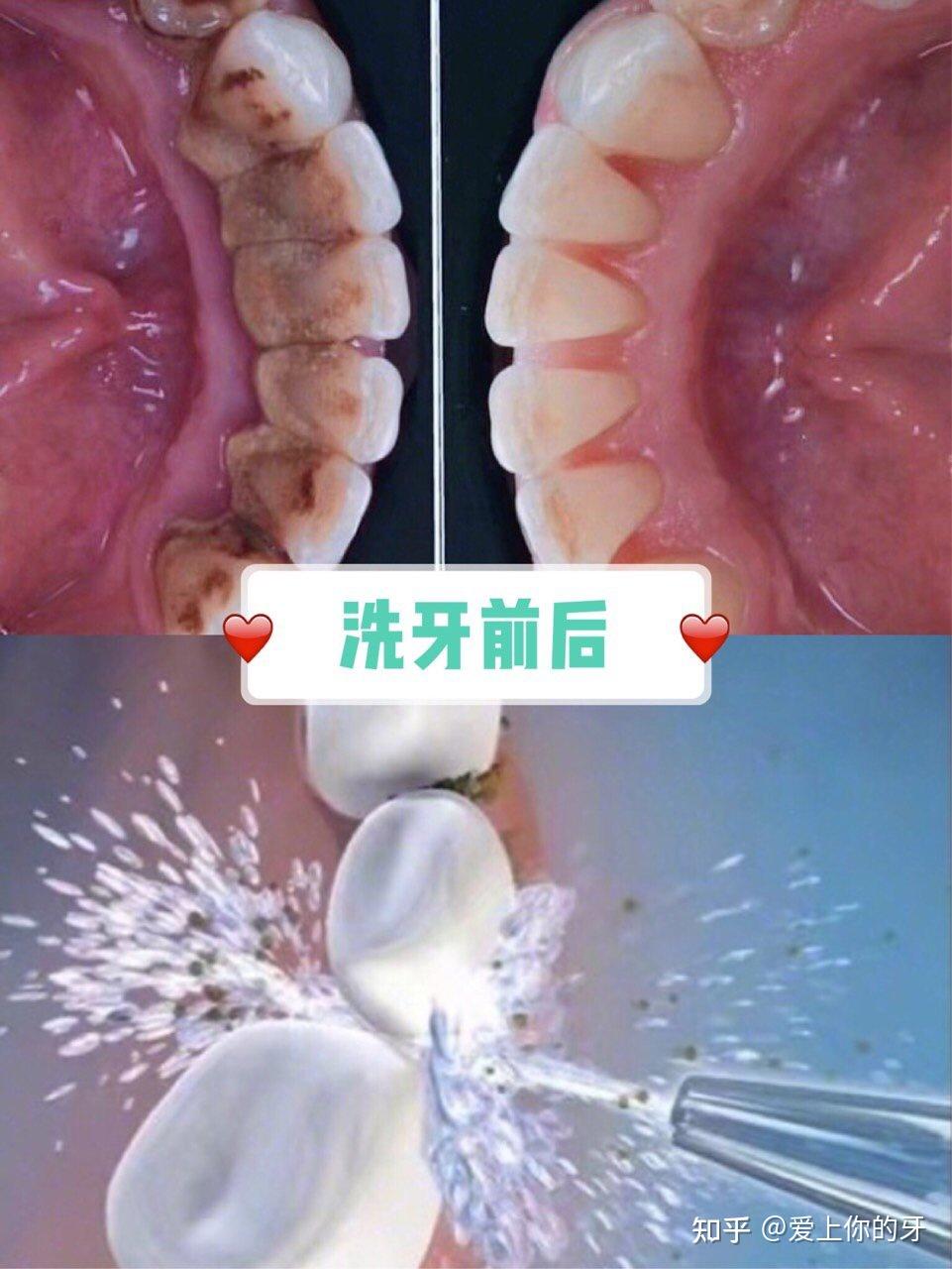 莱芜洗牙可以用医保吗(洗牙可以用医保吗,报销比例多少)